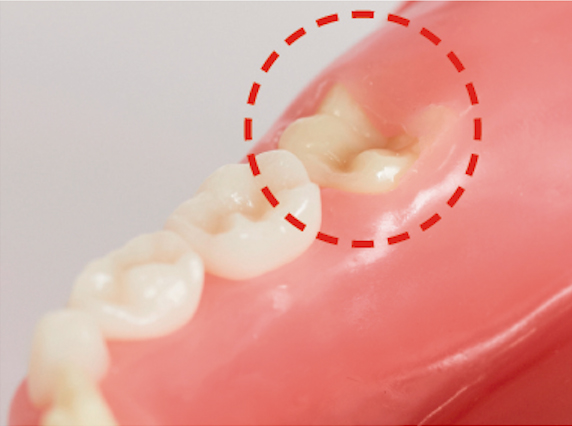 むし歯になりやすい生え変わり期の歯をむし歯から予防する３つのポイント Hugkum はぐくむ