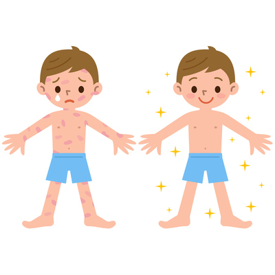 肌トラブルから守る　子どものかゆみ原因や症状、対処法