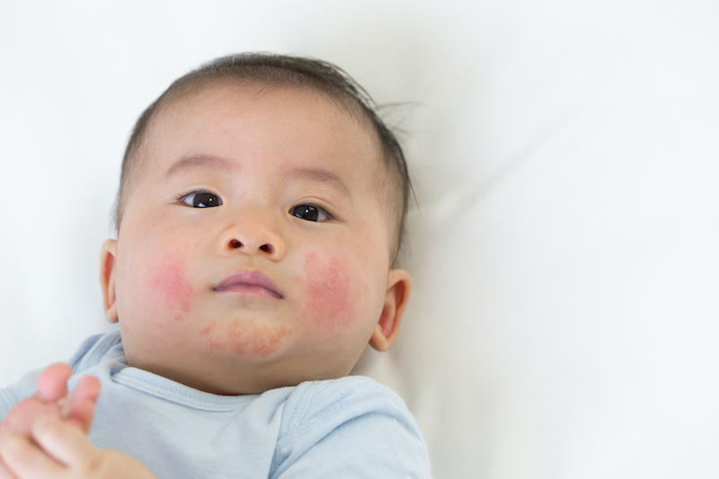 赤ちゃんの乳児脂漏性湿疹の原因や症状が出やすい場所は 期間はいつからいつまで 対処法もチェック 医師監修 Hugkum はぐくむ