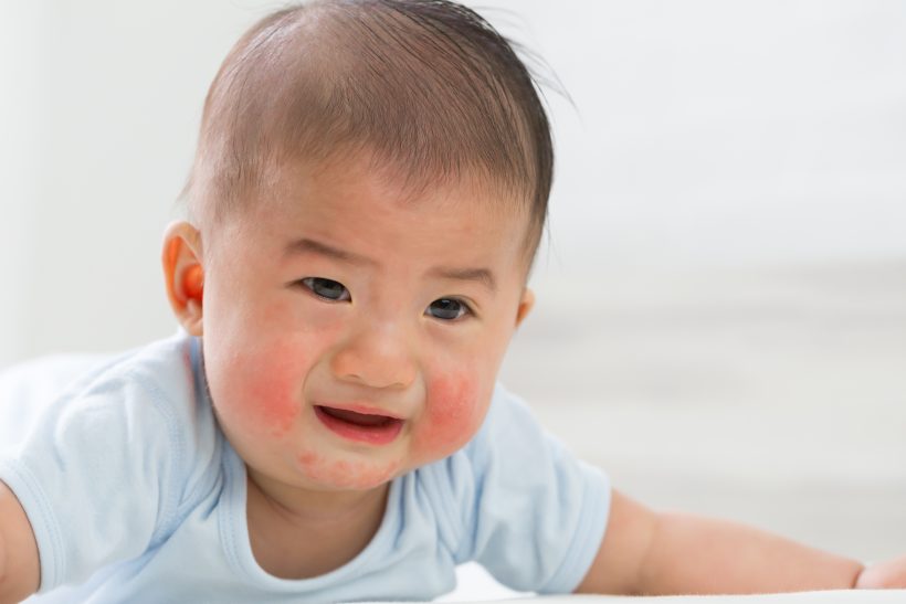 代表的な赤ちゃんの湿疹