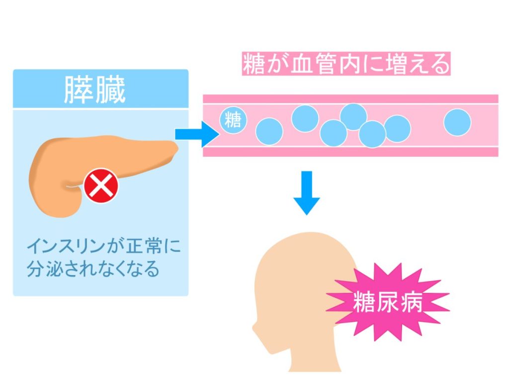 すい臓からインスリンの分泌が十分にできなくなると糖尿病に