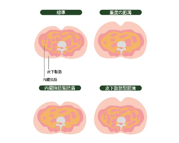 長期経過にて脱分化した後腹膜脂肪肉腫の1例 – 腫瘍熱を契機に発見された後腹膜脂肪肉腫再発の1例 – NZUQ